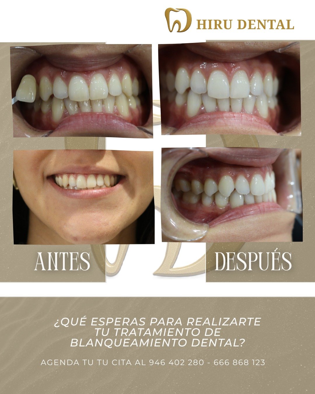 Antes y después blanqueamiento clínico
