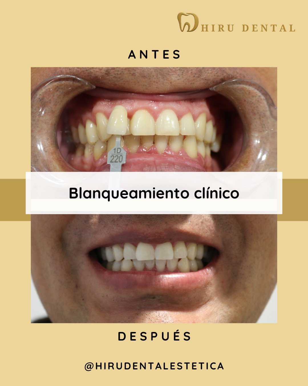 Antes y después blanqueamiento dental