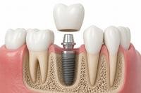 Implante dental con corona sobre la mandíbula