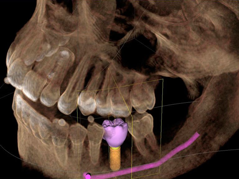 Muestra TAC Dental en detalle