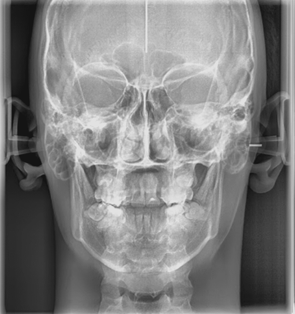 Toma de una telerradiografía frontal