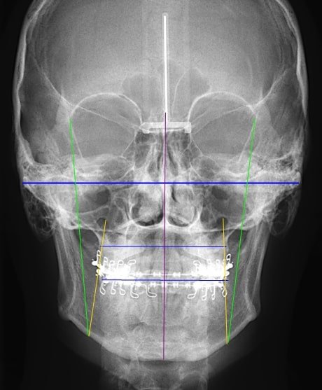 Telerradiografía frontal de cráneo