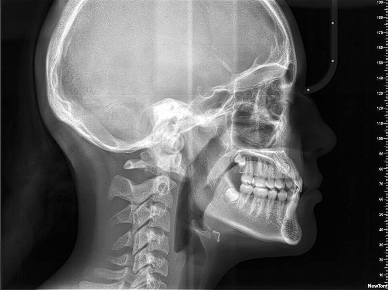 Toma de una telerradiografía lateral