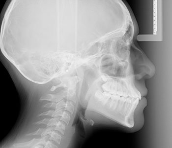 Telerradiografía lateral de cráneo