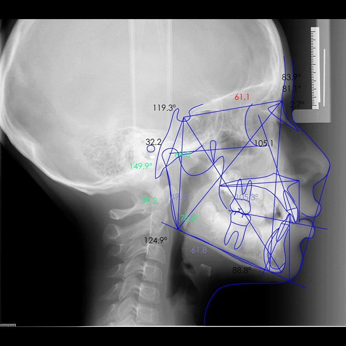 Trazado cefalométrico sobre telerradiografía lateral